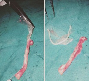 condon en apendice