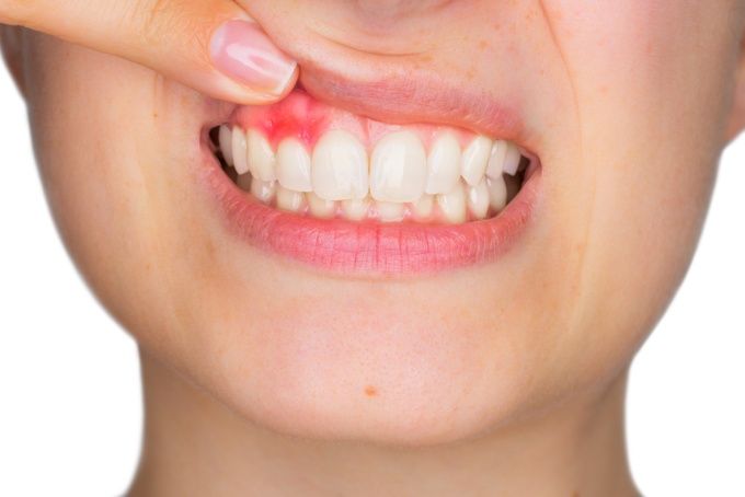 gingivitis_.jpg_1649232000