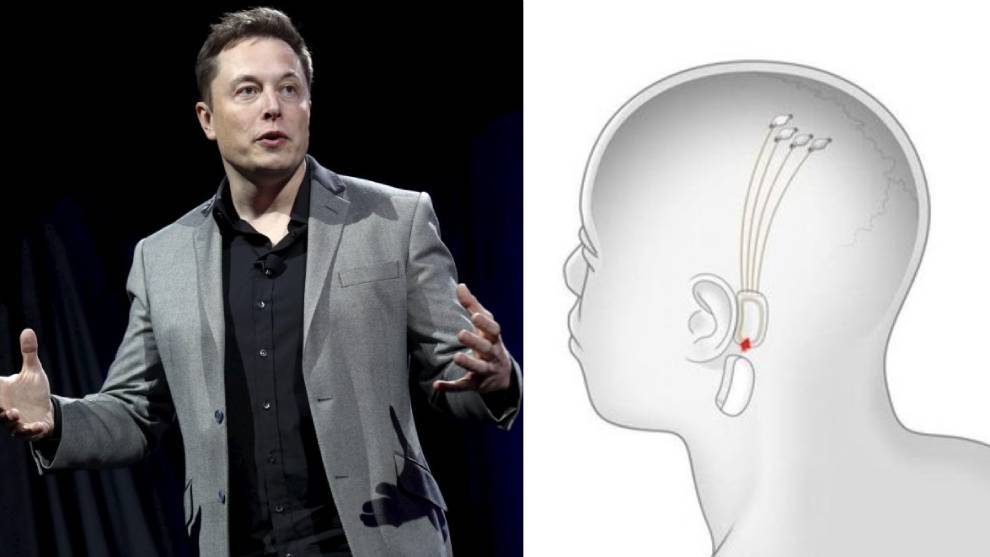 Neuralink