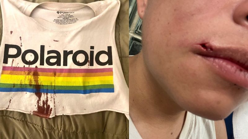 Agresion Homosexual viruela - HeraldoUSA