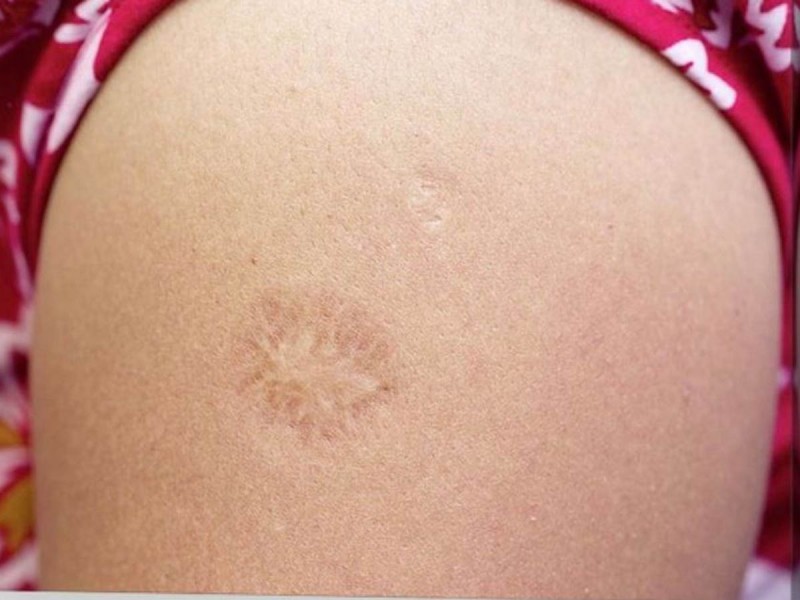 Cicatriz brazo viruela - Excelsior.com