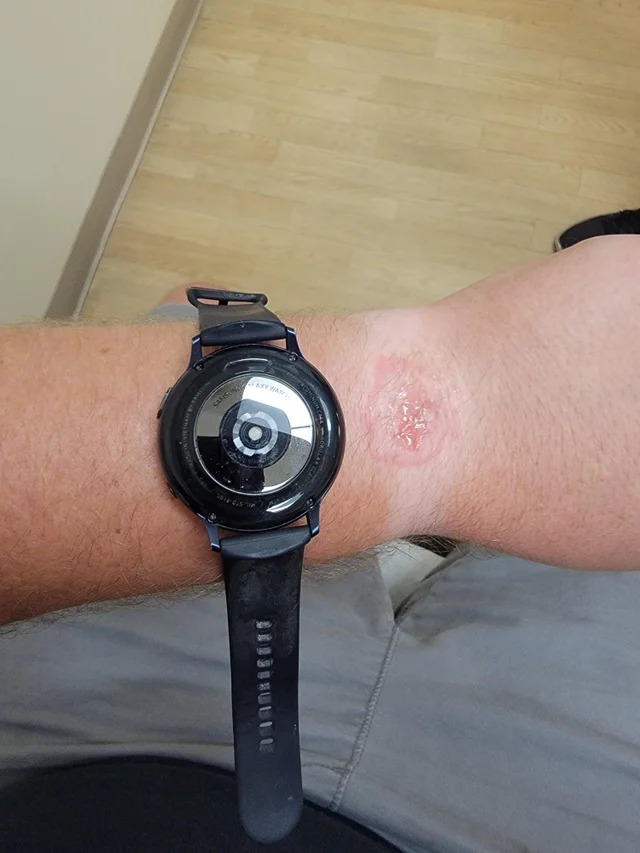Reloj Quemadura - Gizmodo
