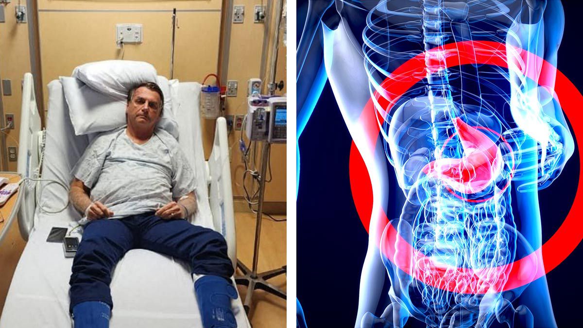 adherencia-abdominal-jair bolsonaro