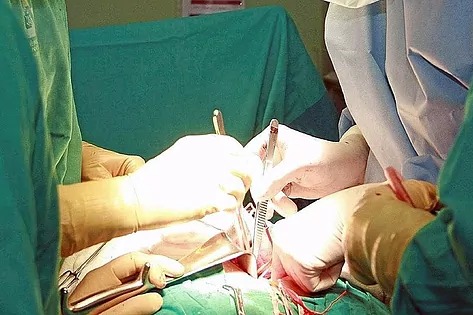 Operacion - elmundo